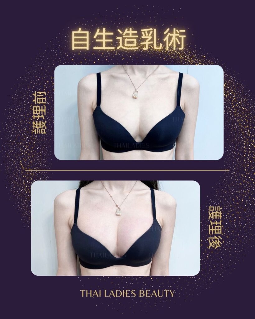 自生造乳術