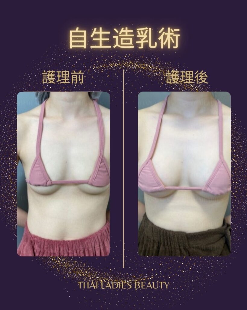自生造乳術