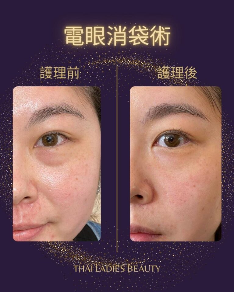 去眼袋,去黑眼圈