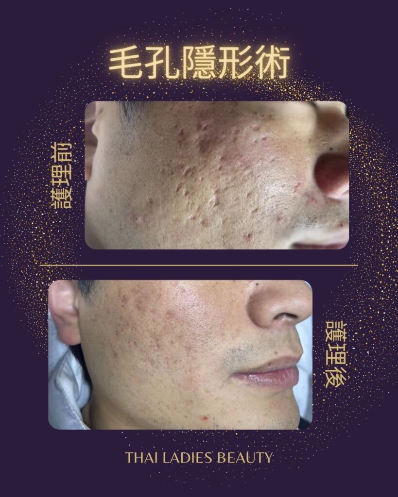 毛孔隱形術