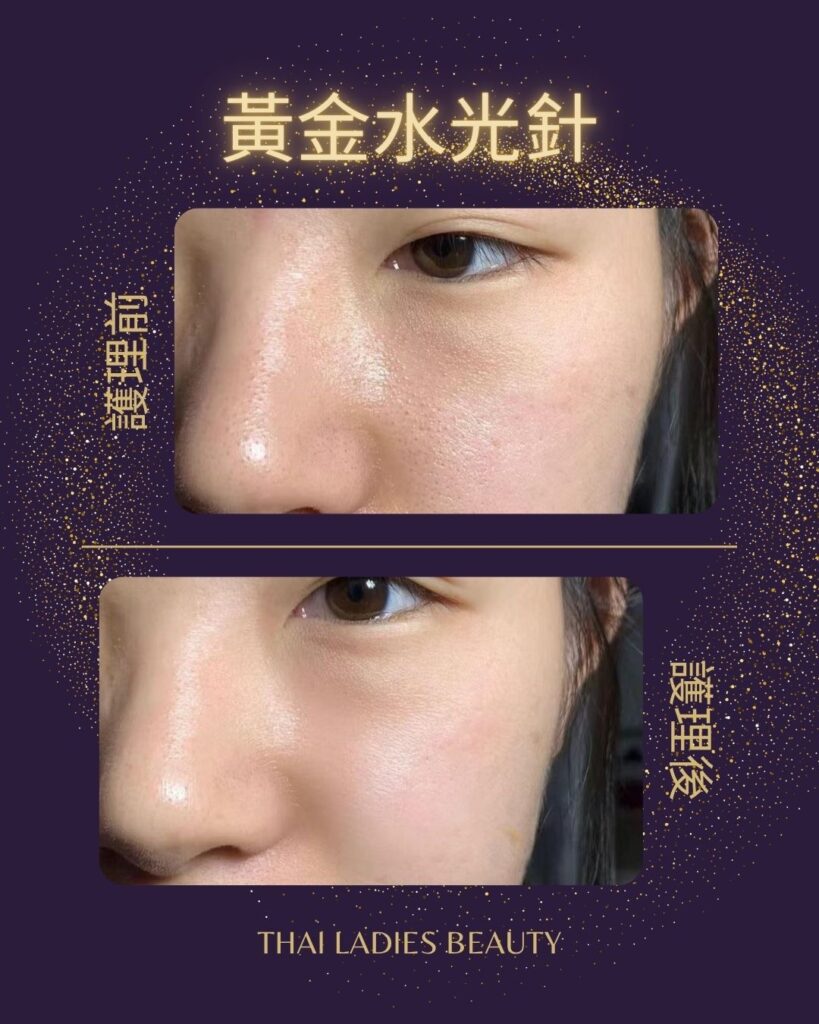 黃金水光針