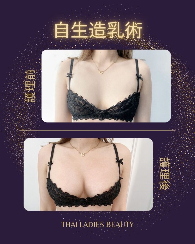 自生造乳術
