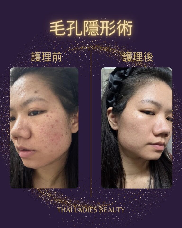 毛孔隱形術