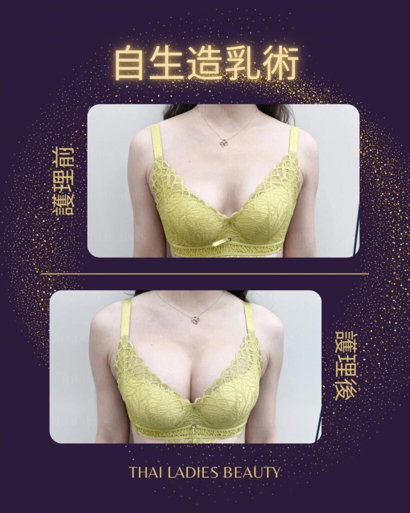 自生造乳術