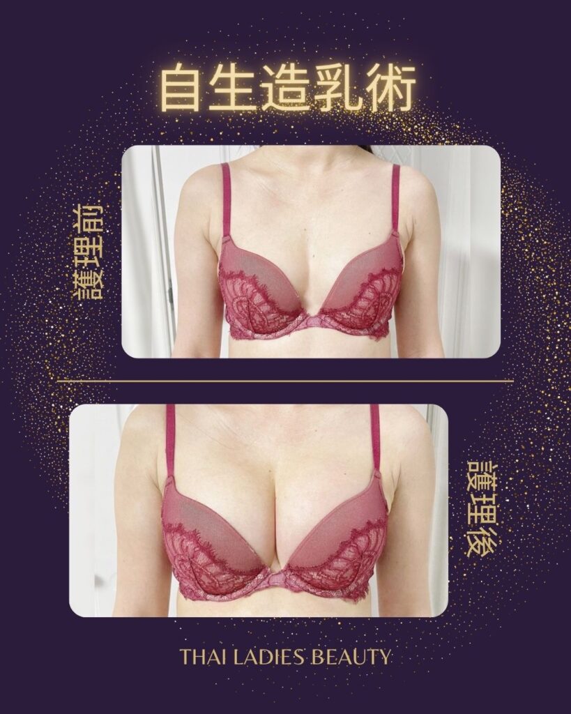自生造乳術