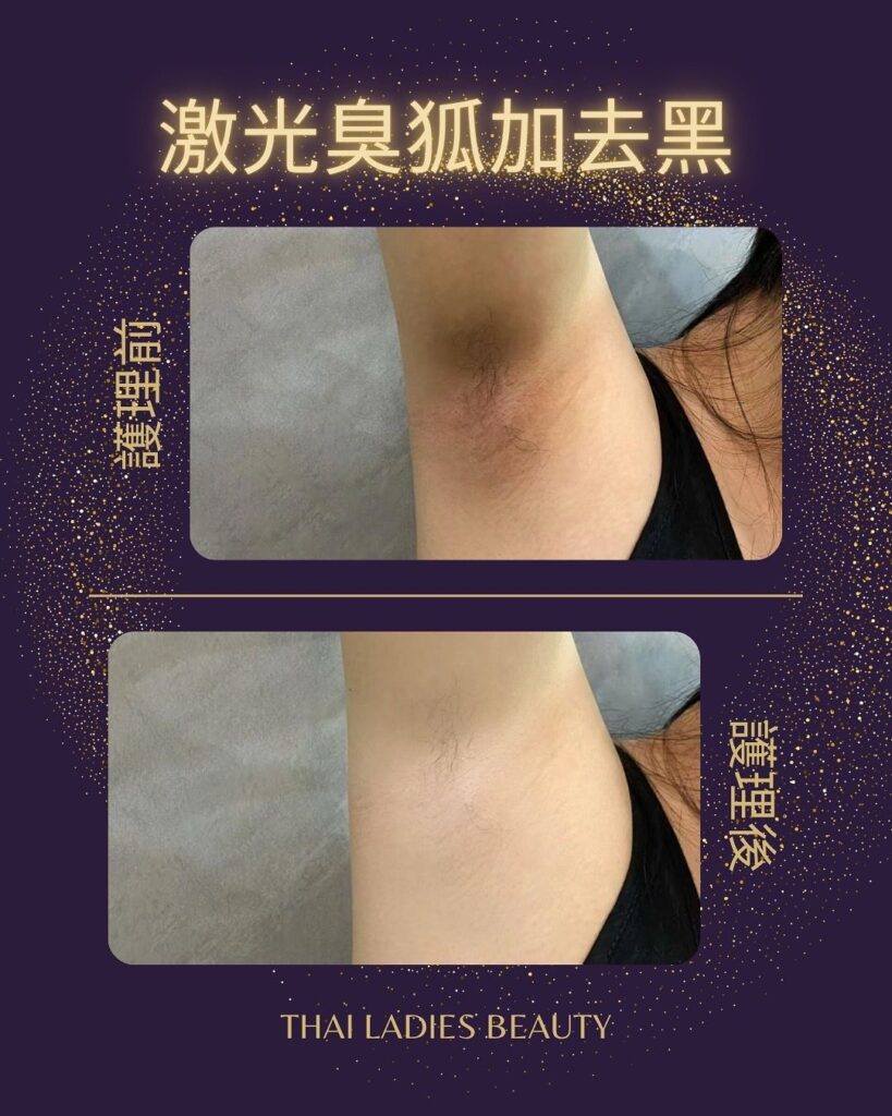 激光除臭狐
