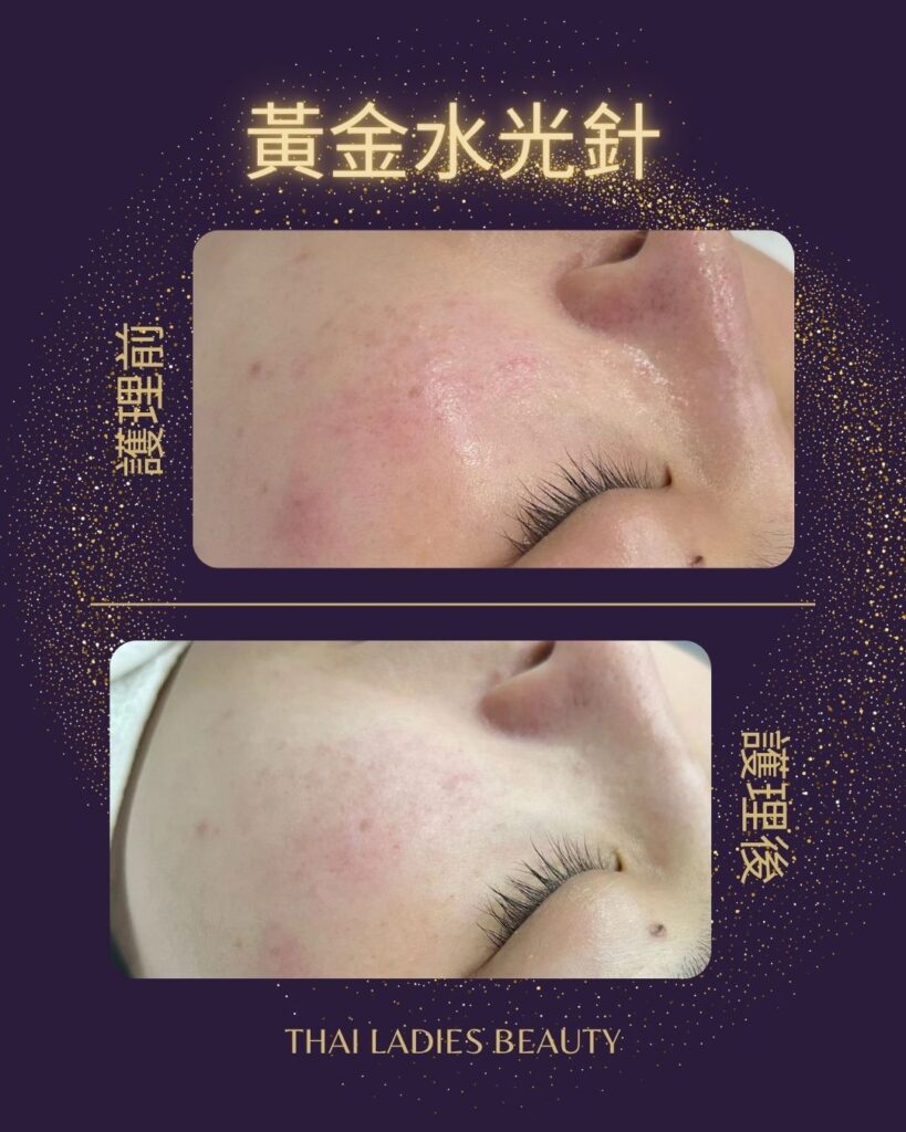 黃金水光針
