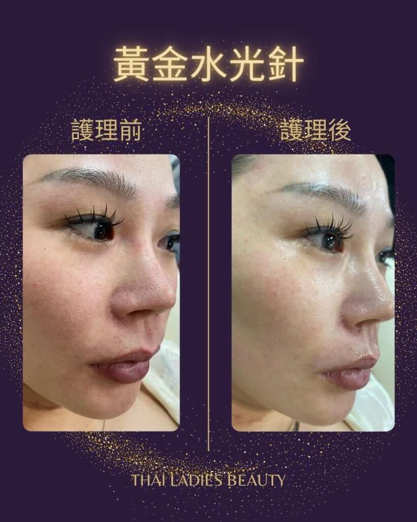 黃金水光針