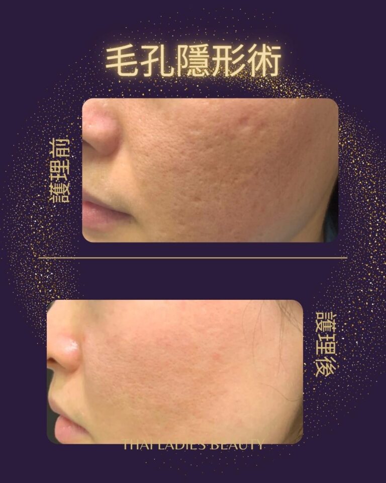 毛孔隱形術