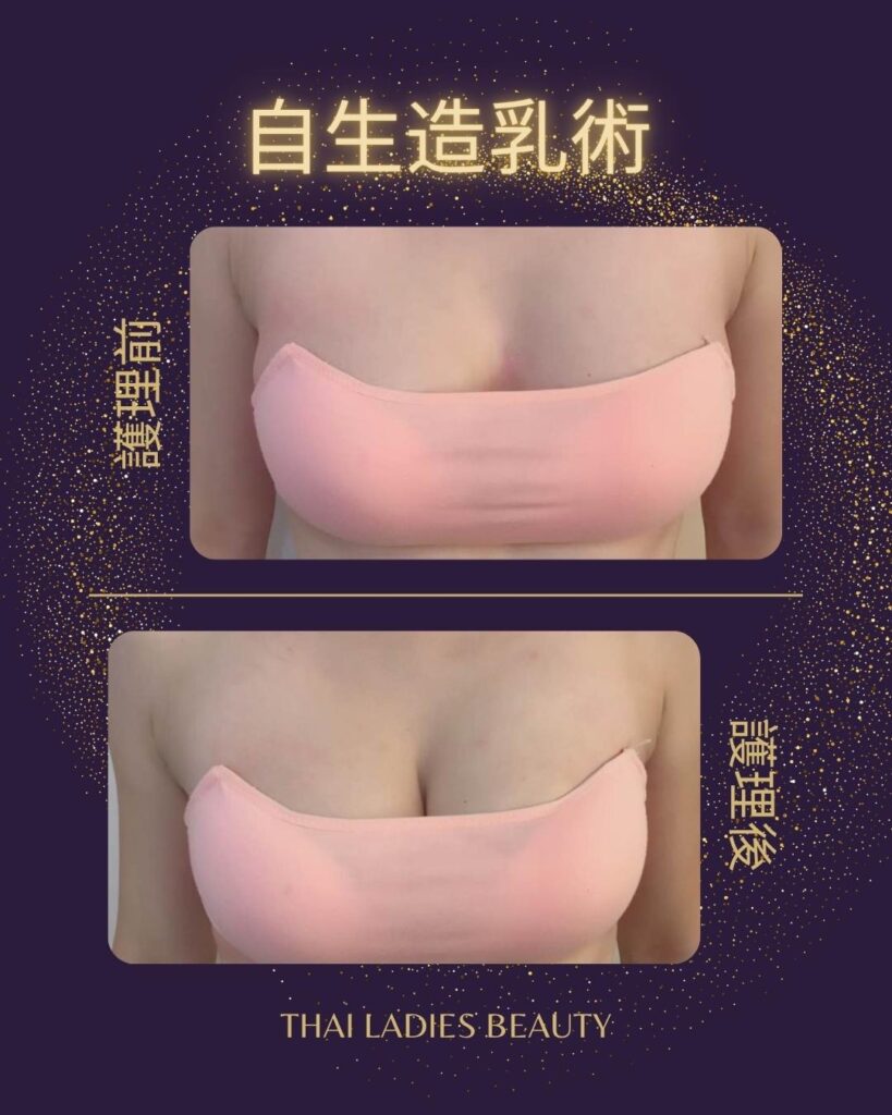 自生造乳術