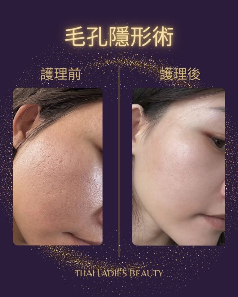 毛孔隱形術