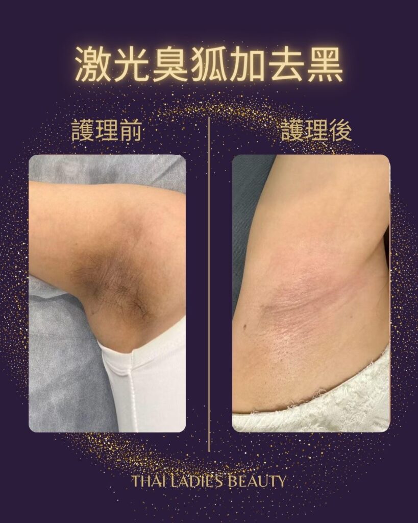 激光除臭狐