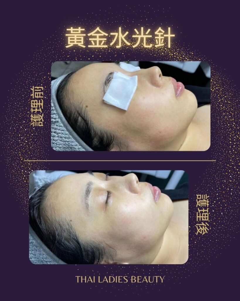黃金水光針