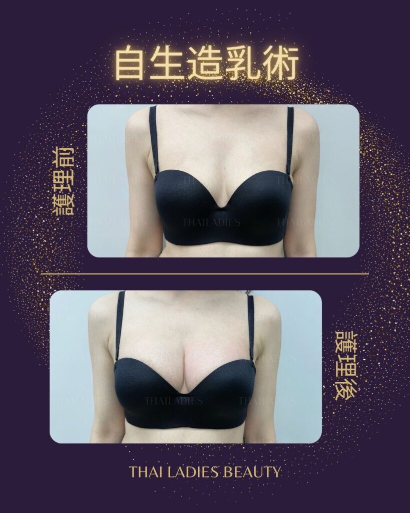 自生造乳術