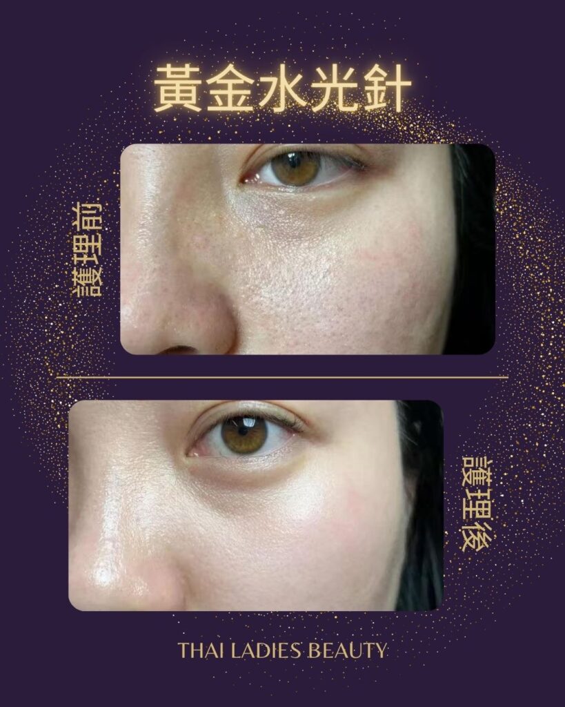 黃金水光針