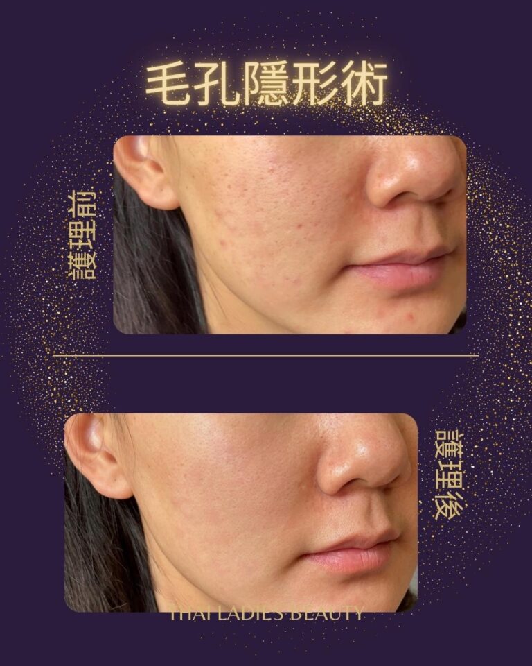 毛孔隱形術