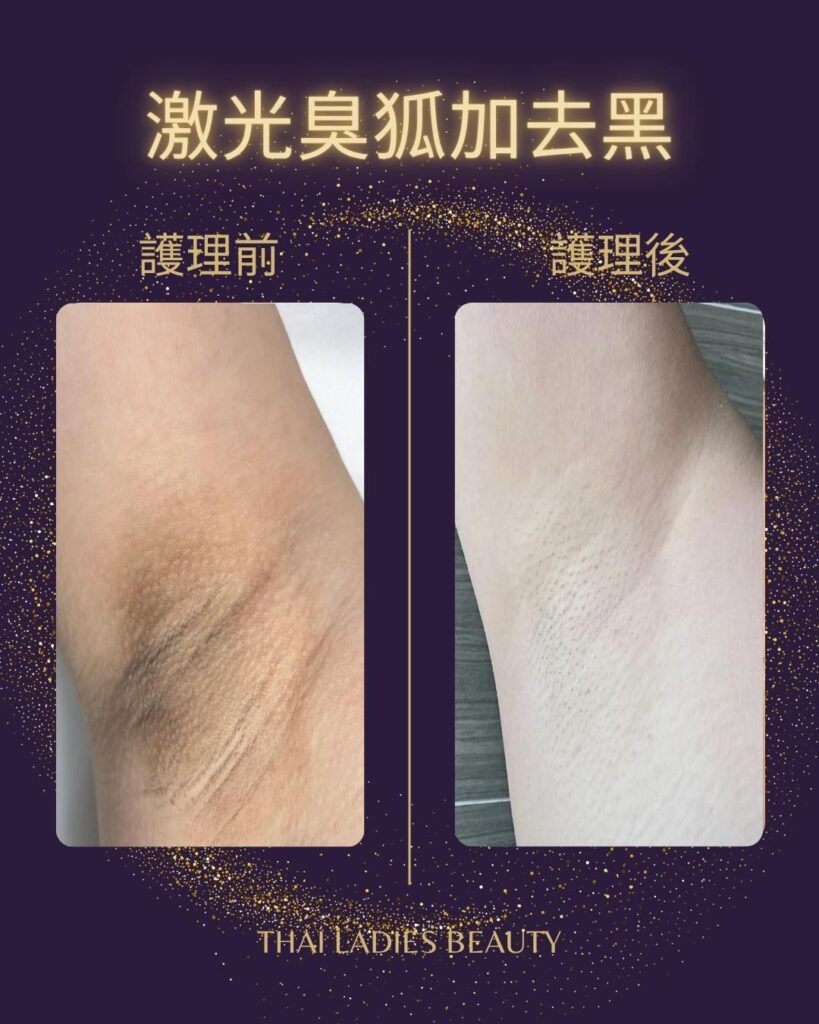 激光除臭狐