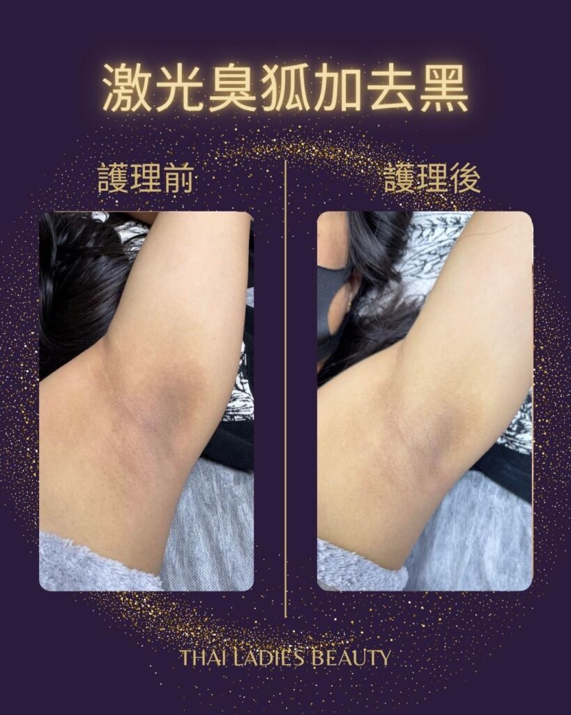 激光除臭狐