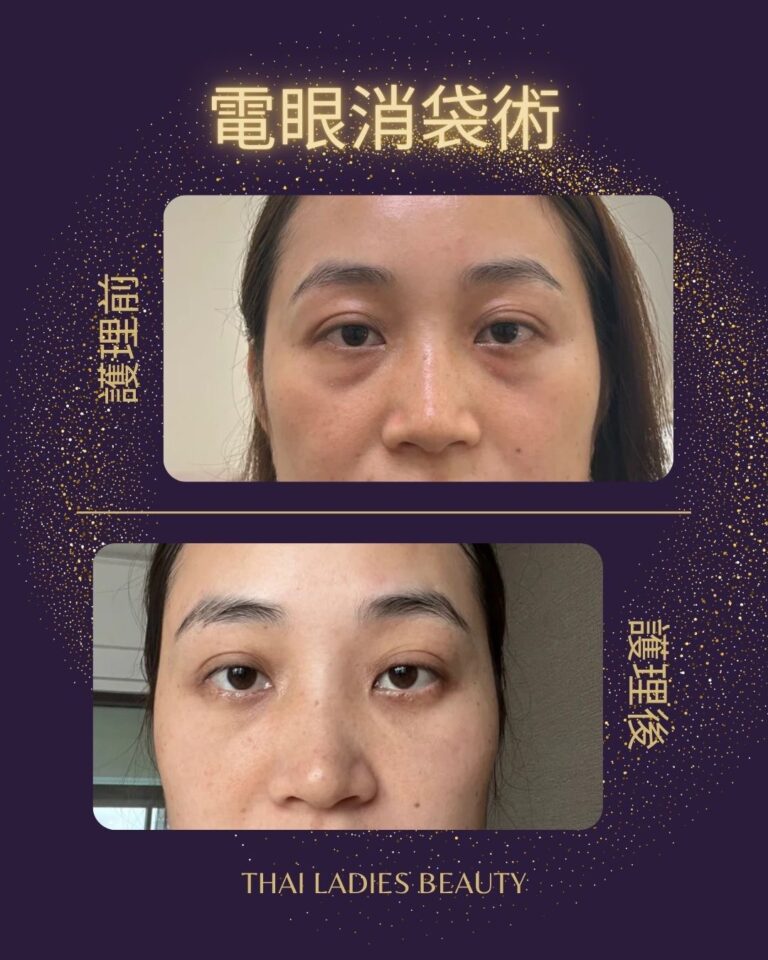 電眼消袋術：西班牙尖端科技煥活眼周，重鑄無痕明亮雙眸