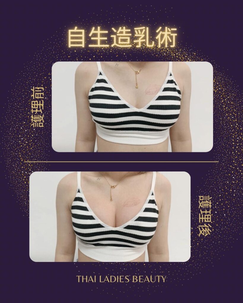 自生造乳術