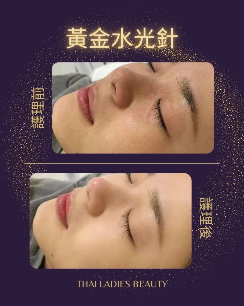 黃金水光針