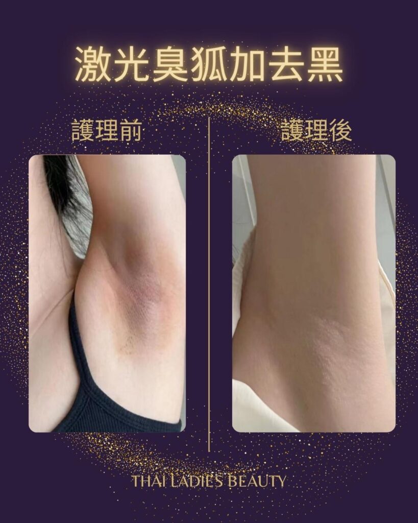 激光除臭狐