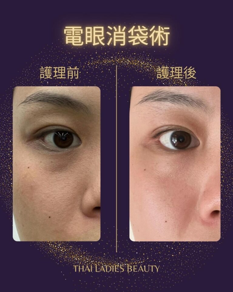 去眼袋,去黑眼圈