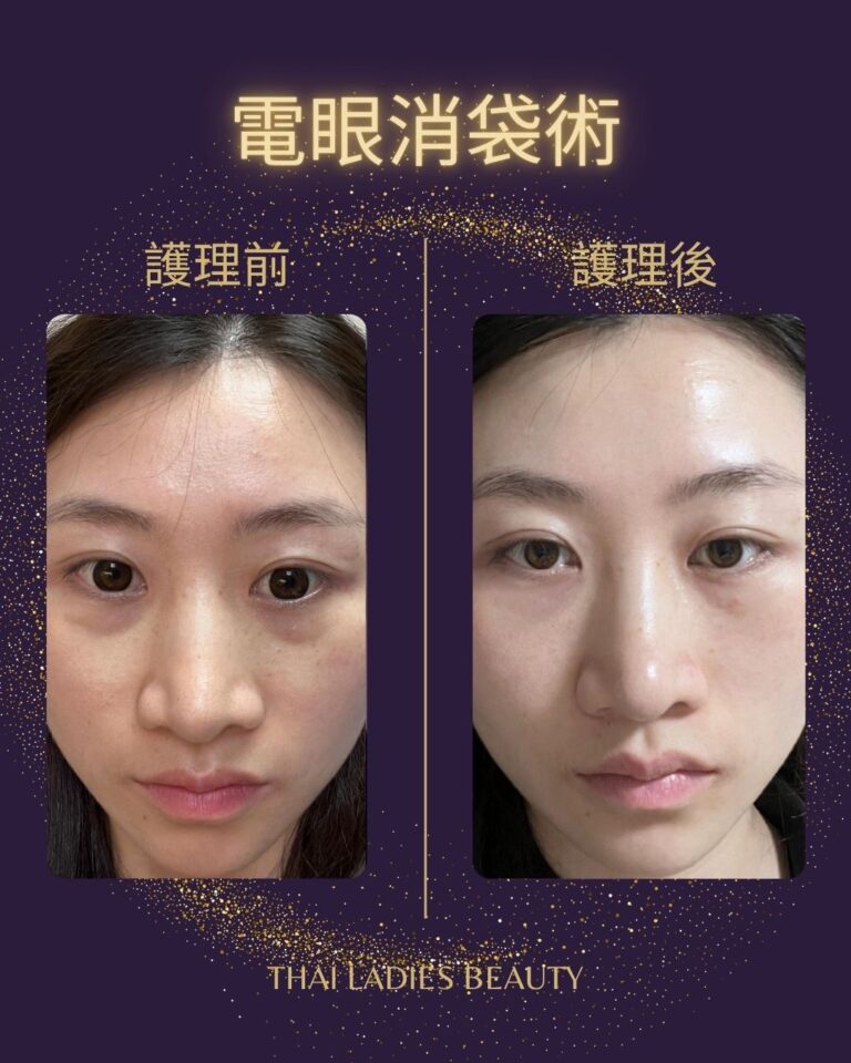 電眼消袋術：西班牙尖端科技煥活眼周，重鑄無痕明亮雙眸 在現代快節奏生活中，熬夜加班、長期使用電子設備、年齡增長等因素，讓眼袋、黑眼圈、眼紋等問題頻頻困擾著人們。一雙疲態盡顯的眼睛，不僅影響外貌，更會讓人看起來精神萎靡。如今，電眼消袋術攜手西班牙尖端科技強勢登場，為無數受眼周問題困擾的人士帶來了重獲明亮無痕雙眸的希望！ 在現代快節奏生活中，熬夜加班、長期使用電子設備、年齡增長等因素，讓眼袋、黑眼圈、眼紋等問題頻頻困擾著人們。一雙疲態盡顯的眼睛，不僅影響外貌，更會讓人看起來精神萎靡。如今，電眼消袋術攜手西班牙尖端科技強勢登場，為無數受眼周問題困擾的人士帶來了重獲明亮無痕雙眸的希望！