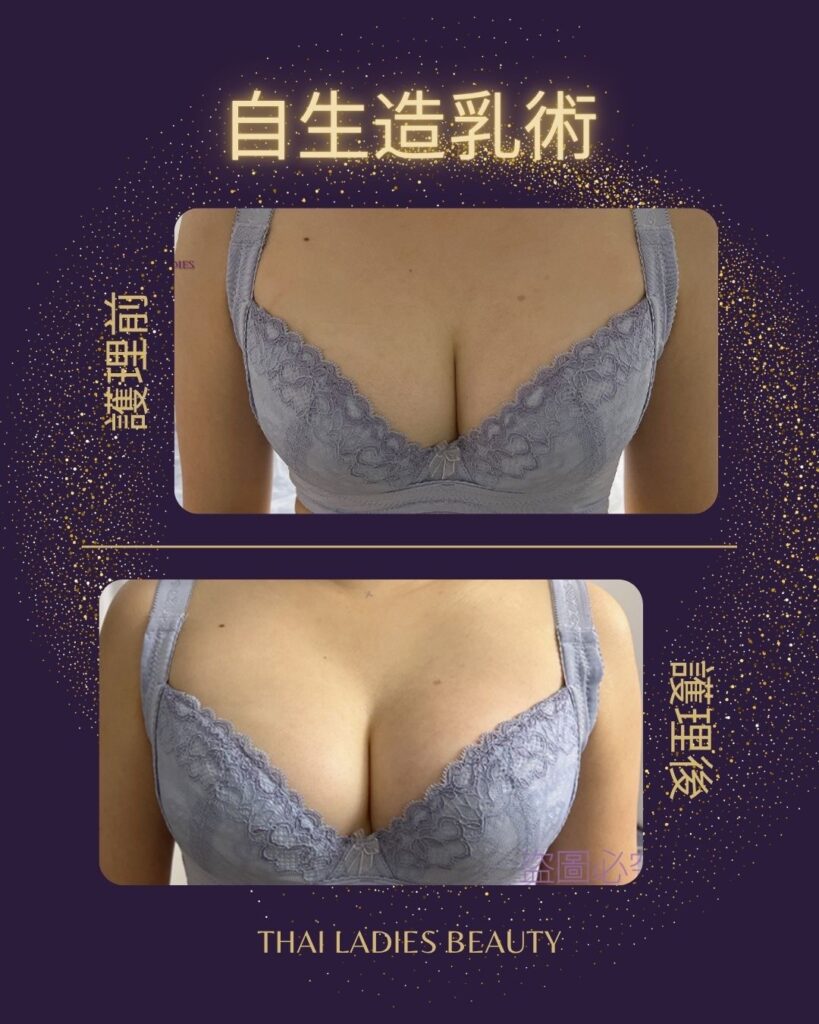 自生造乳術