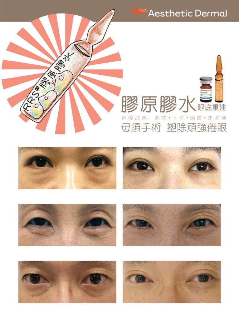 電眼消袋術,去眼袋