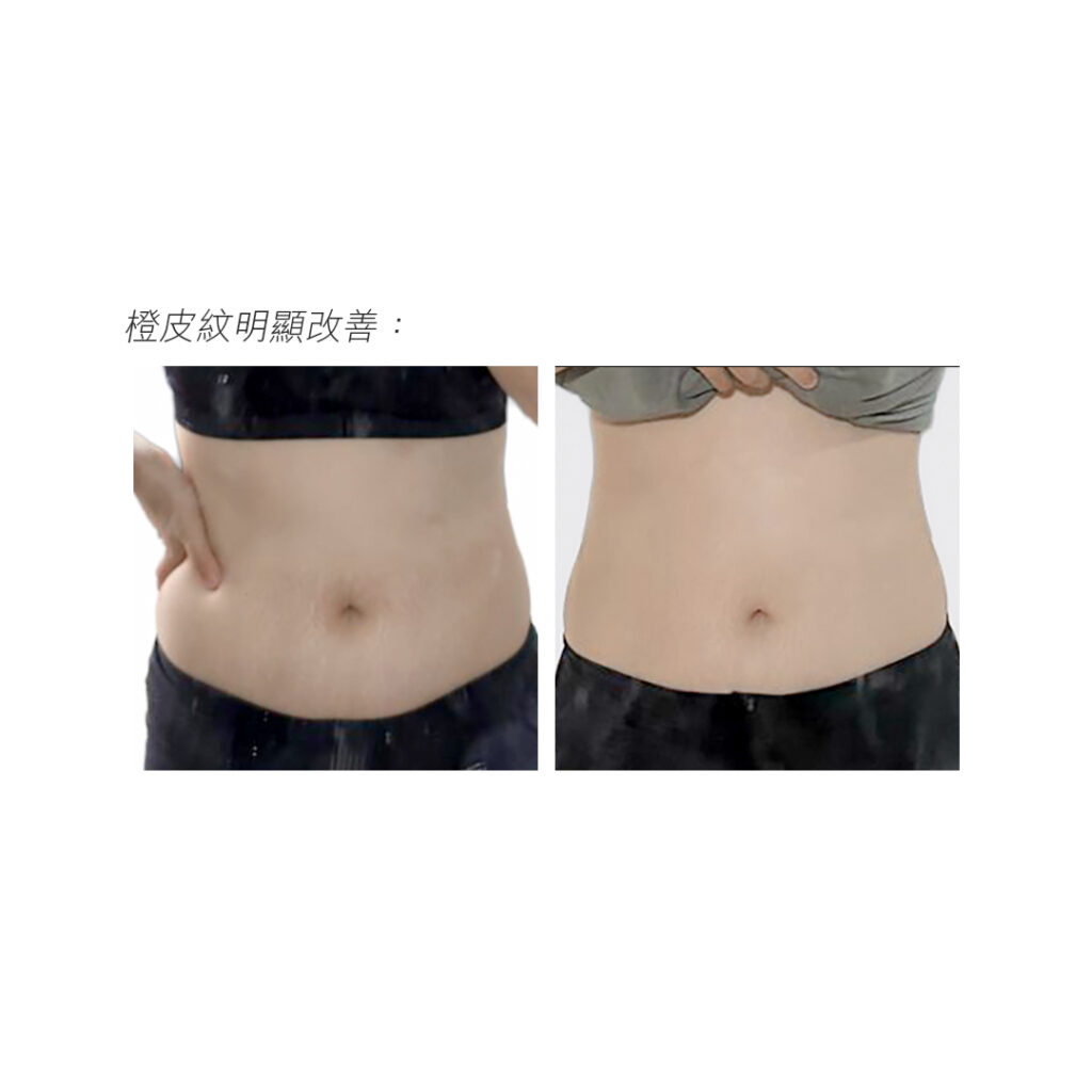 GOLDEN FIT - 橙皮紋