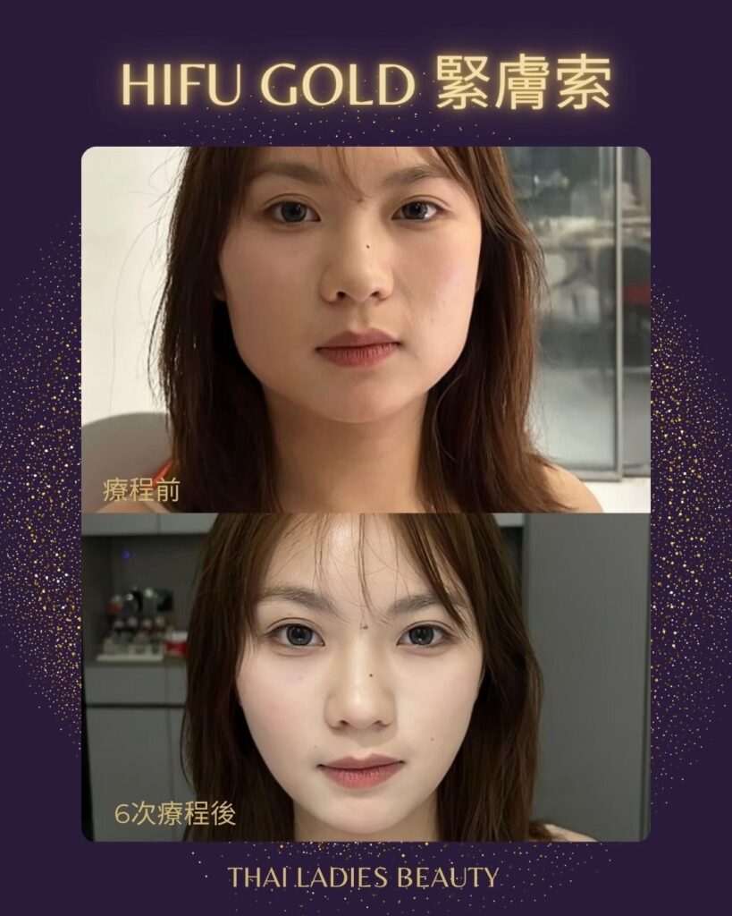 泰女仕 HIFU 黃金索拉療程 - Thai Ladies Beauty & Wellness
