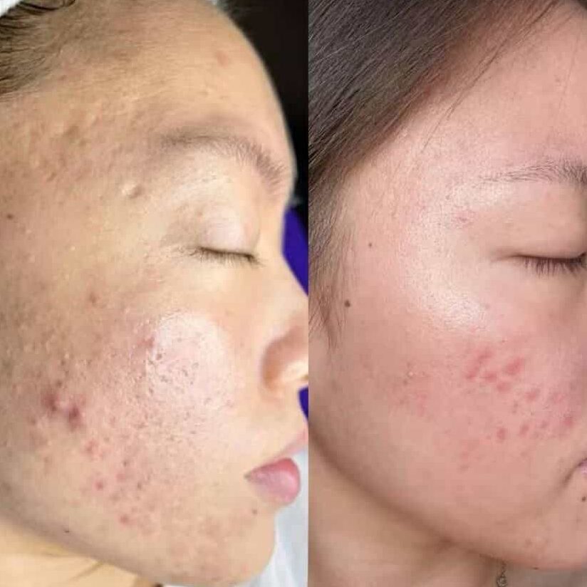 泰女仕古法痘痘修護療程 療程效果 - Thai Ladies Beauty & Wellness 香港